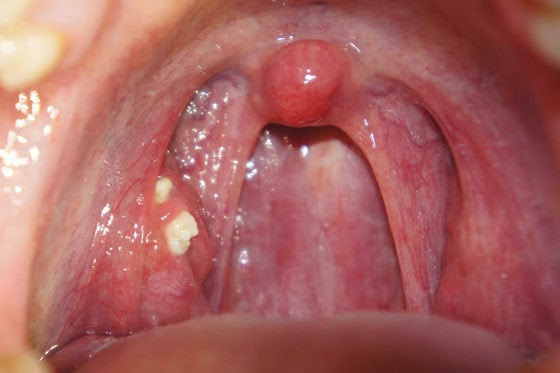 Фарингіт у дітей: симптоми і лікування