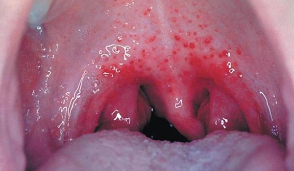 Хронічний тонзиліт у дітей: симптоми та лікування