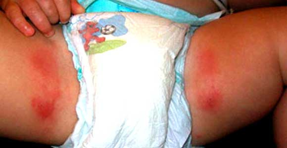 Попрілість між ніг у дитини: причини виникнення та як прибрати