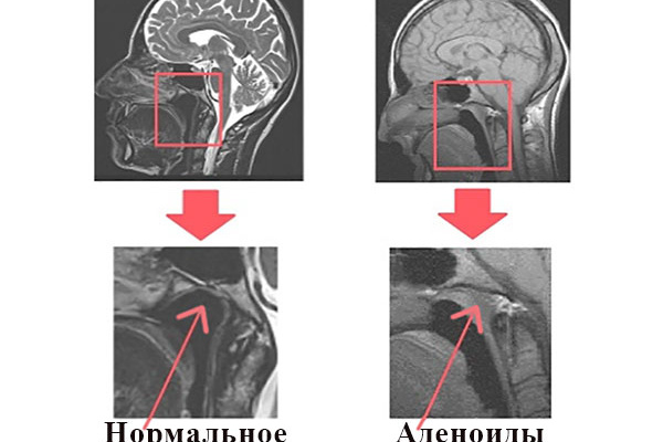 Як лікувати аденоїди першого ступеня у дітей