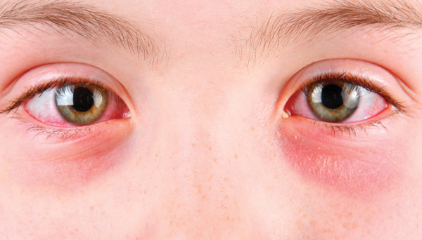 Причини почервоніння під очима у дитини