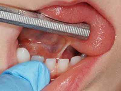 Коротка вуздечка мови у дитини: що робити