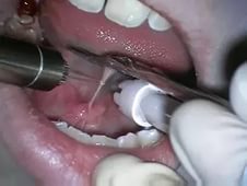 Коротка вуздечка мови у дитини: що робити