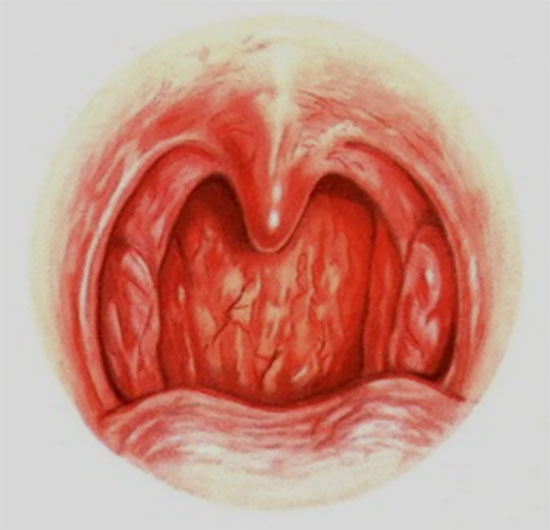 Які бувають види фарингіту у дитини і чим вони відрізняються
