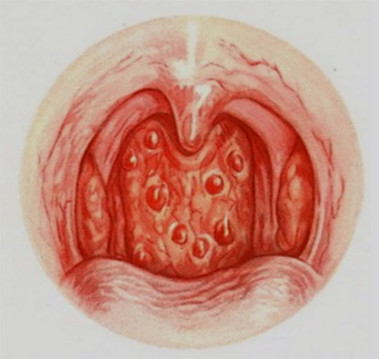 Які бувають види фарингіту у дитини і чим вони відрізняються