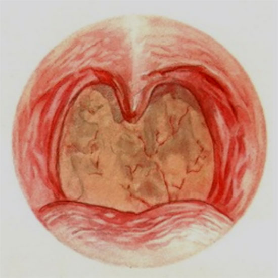 Які бувають види фарингіту у дитини і чим вони відрізняються