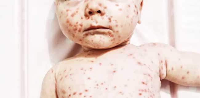 Вітряна віспа у дитини: симптоми і лікування